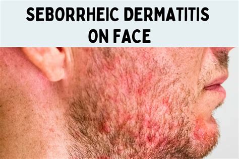 Seborrheic Dermatitis On Face Treatment Causes Symptoms