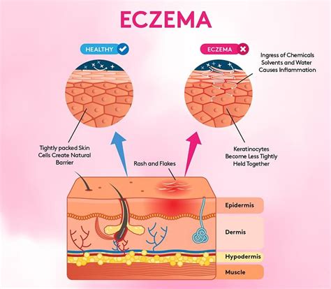 Eczema Symptoms Causes Prevention And Treatment