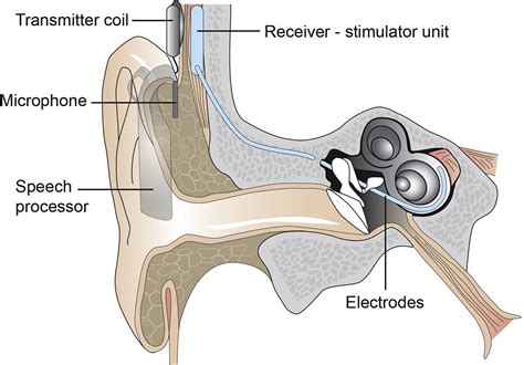 Anaesthesia For Major Middle Ear Surgery Bja Education