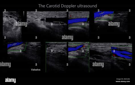 A Carotid Artery Doppler Ultrasound Is A Diagnostic Test Used To Check