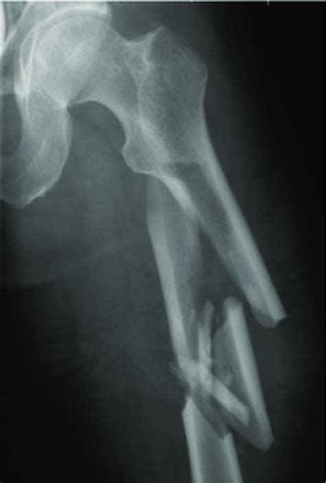 Compound Fractures X Ray