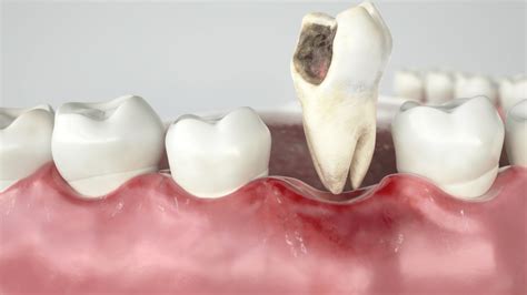 The Healing Procedure After Tooth Extraction Cards Dental