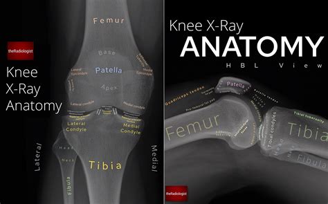 Labeled Knee X Ray Anatomy By Dr Naveen Sharma Grepmed