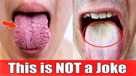 What Causes White Tongue Fastest Way To Get Rid Of White Tongue And Bad