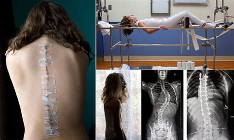 Brave Teenager Documents Her Intense Treatment For Scoliosis In 2021 Scoliosis Scoliosis