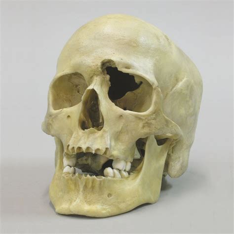 Take for instance, george floyd. Human Male Skull with a .32-Caliber Gunshot Wound ...