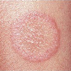 Kulit kering atau xerosis adalah keluhan umum yang terjadi ketika kulit mulai terasa gatal akibat kehilangan kelembapannya. Gatal Dan Ruam Kulit Pada Selangkangan - Tanya Alodokter