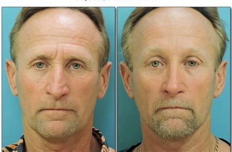 facial rejuvenation for men napa solano plastic surgery