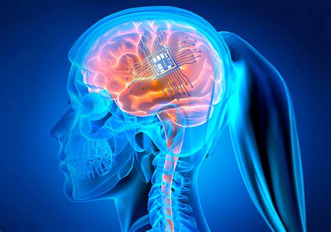 Will Neuralinks Brain Implant Help Paralysis Victims Mind Matters