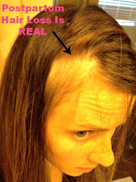 The reason behind this is that hair enters in resting phase before shedding. The Truth About Postpartum Hair Loss | Postpartum hair ...