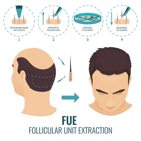 Your hair is going to look thicker, longer, and more intensive. What Are the Stages of a FUE Hair Transplant? - HairWiki