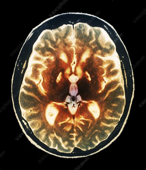 Anoxia Brain Damage Mri Scan Stock Image C0041466 Science Photo