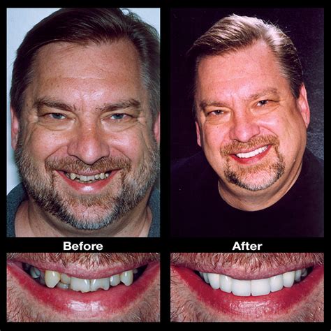 Crooked Teeth Before And After