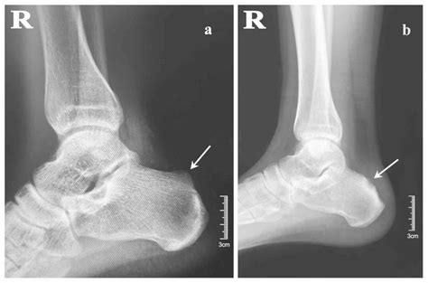 Functional Followup After Endoscopic Calcaneoplasty For Haglund S