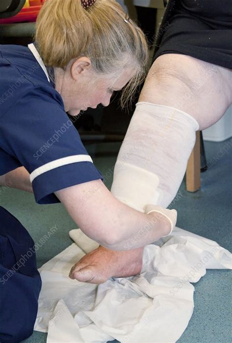 Nurse Dressing A Patients Leg Stock Image C0135193 Science