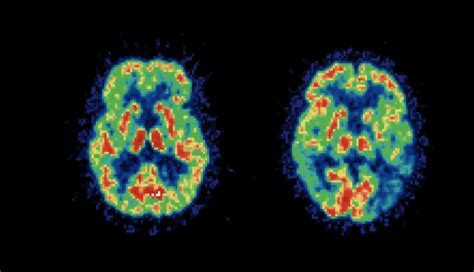 Brain Scans May Predict Efficacy Of Cbt For Social Anxiety Disorder