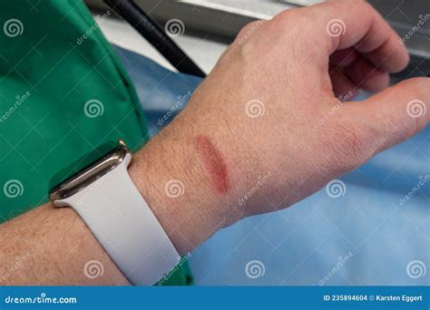 The Inflamed Burn Is On A Wrist Stock Photo Image Of Design