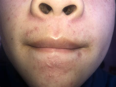 Skin Concerns Acne On Upper Lip From Shaving Chin Is Very Inflamed