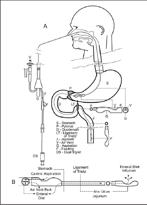 Figure 9 From Dual Purpose Gastric Decompression And Enteral Feeding