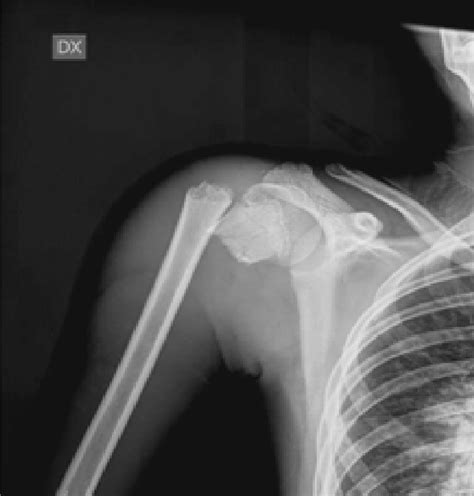A Displaced Proximal Humeral Fracture Neer Iv Download Scientific