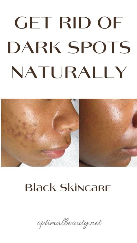 Black Skin Care Dark Spots Black Spots On Face Acne Dark Spots Brown
