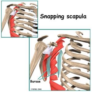 The syndrome is said to be one of the rare one in the human body but may cause trouble, pain and uncomfortable feelings in the scapula joint. Snapping Scapula Syndrome & Causes