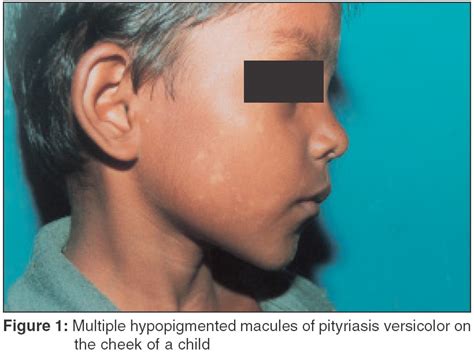 Pityriasis Versicolor In The Pediatric Age Group Indian Journal Of