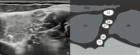 Ultrasound Image Of The Interscalene Groove In Supraclavicular
