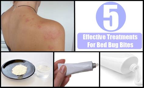 5 Effective Treatments For Bed Bug Bites Natural Home Remedies