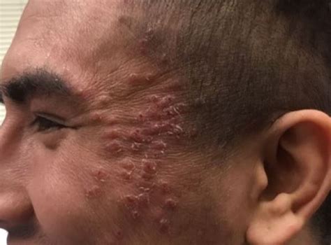 Acne Conglobata On Scalp