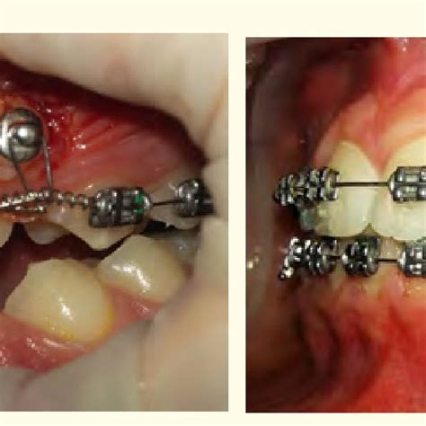 A Lingual Button After Surgical Exposure Of Tooth 23 Was Applied B