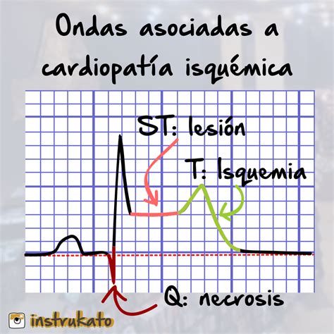 Diagn Stico Electrocardiogr Fico Del Infarto Agudo Al Miocardio Iam