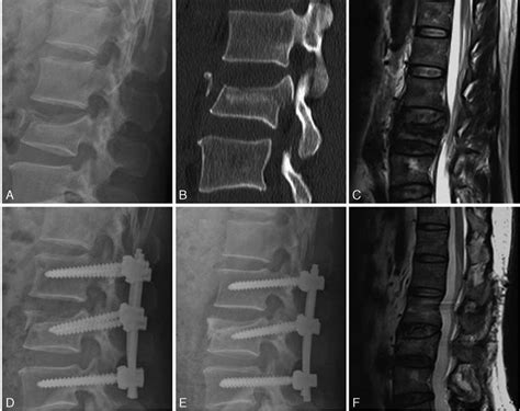 A 46 Year Old Man With L2 Burst Fracture Preoperative Lateral