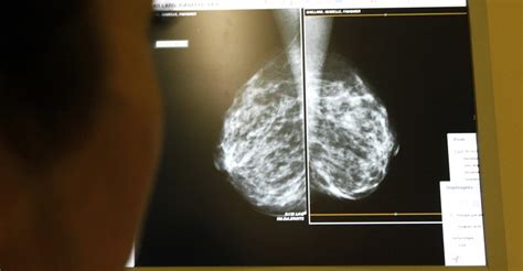 What Dense Breasts Mean For Cancer Risk The Atlantic
