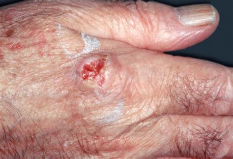 Skin Cancer Risk Higher In Patients With Atopic Dermatitis Clinical
