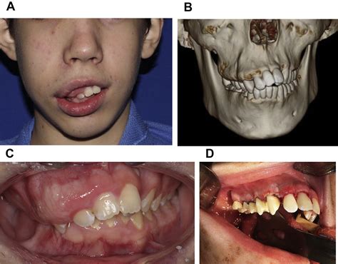 Jaw And Dental Abnormalities Dental Clinics