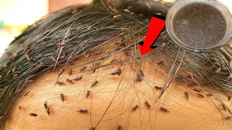 How To Remove Lice Eggs And Lice In Hair Permanently Youtube