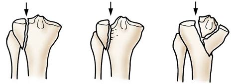 Tibial Plateau Fracture Causes Types Symptoms Diagnosis And Treatment