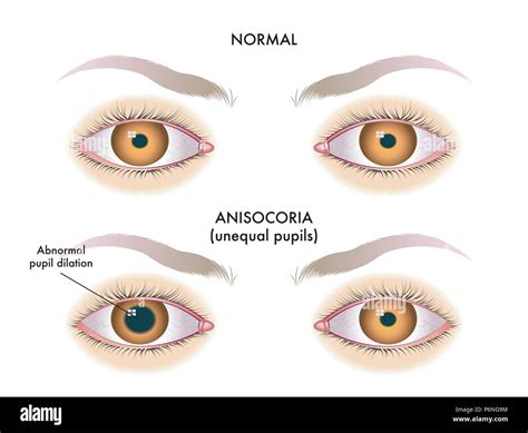 Vector Medical Illustration Of The Symptoms Of Unequal Pupils Also