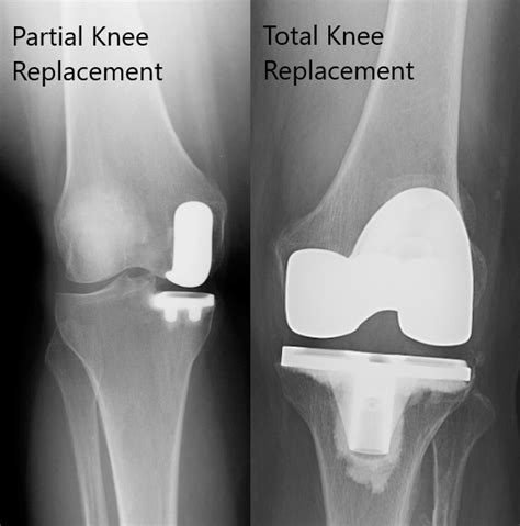 Knee Arthroplasty Partial Versus Total • Paul N Morton Md