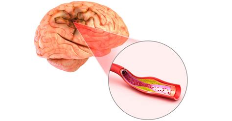 Blood Clot In The Brain Symptoms Causes And Treatment