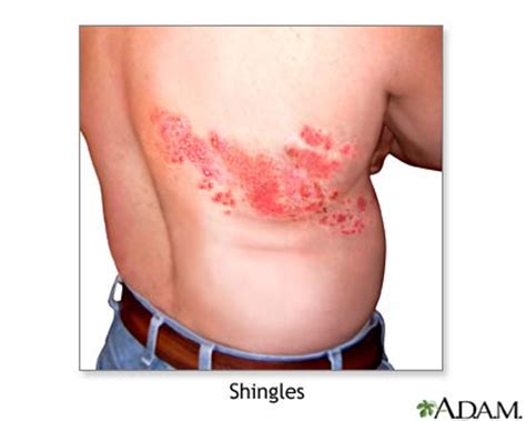 Agree, i would not want to encounter this, so you probably wanted to know how and what to treat herpes rash. Varicella Zoster virus | | How to cure shingles