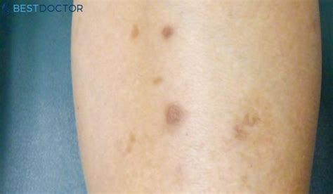 Brown Spots On Legs And Feet Causes Treatment Pictures By Dr Ahmed