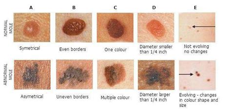 Abcdef S Of Changing Moles Melanoma Pine Belt Dermatology Skin Cancer Center General