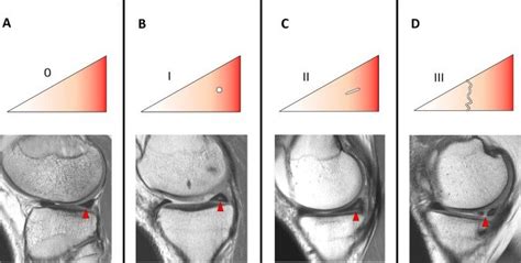 Meniscal Tear Grading The Schematic Diagrams On The Top Depict