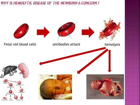 Hemolytic Disease Of The Newborn Rh Isoimmunization