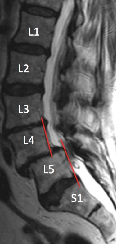 Mri Lumbar Spine Anatomy Rocky Mountain Brain And Spine Institute