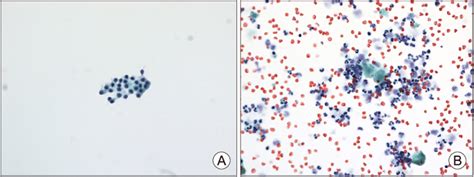 A Fna Cytology Showed Normal Thyroid Follicular Cells Without