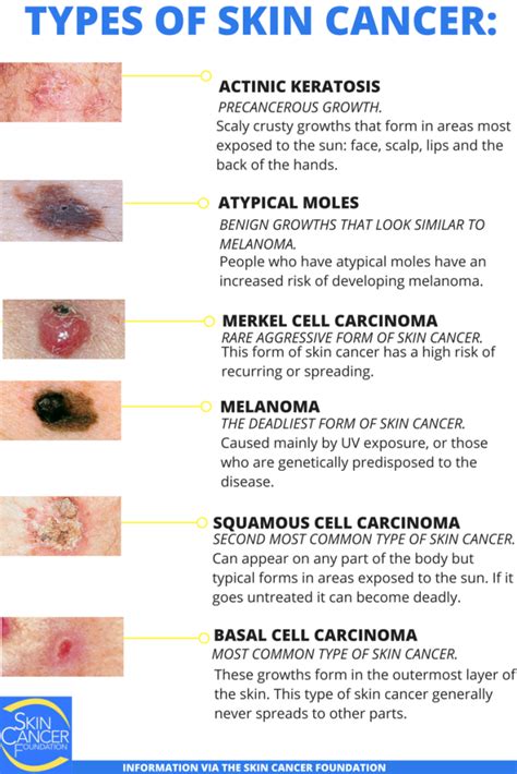 Skin Cancer Types Basal Cell Carcinoma Bcc Squamous Cell