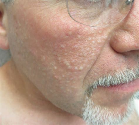 Multiple Facial Papules Mdedge Dermatology